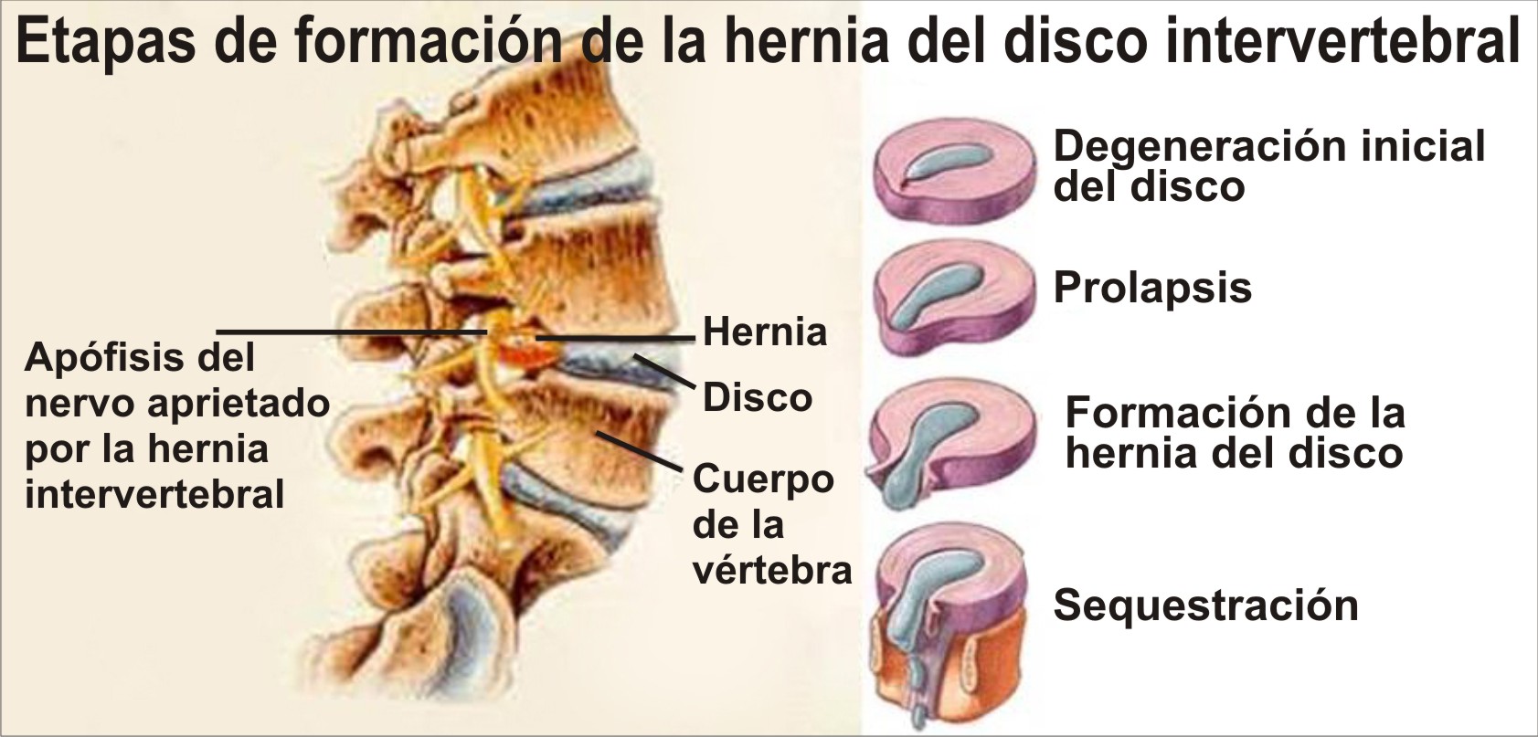 Proceso hernia
